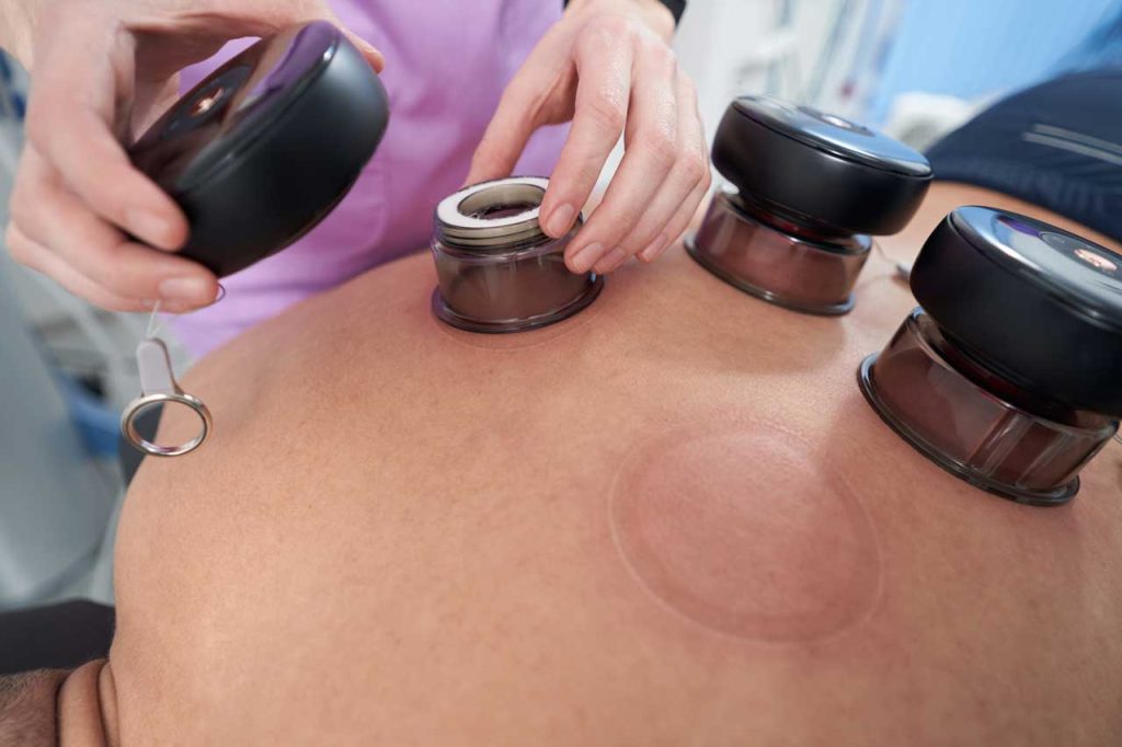 Cupping Massage